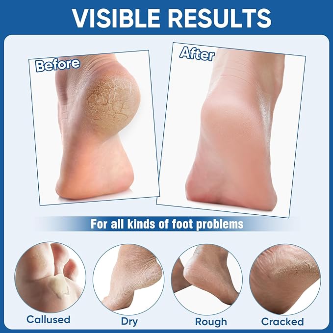 Nano Glass Foot File, Foot Callus Remover & Scrubber for Smooth Feet, Professional Pedicure Tool (Heel Socks & Cracked Heel Stick Included)
