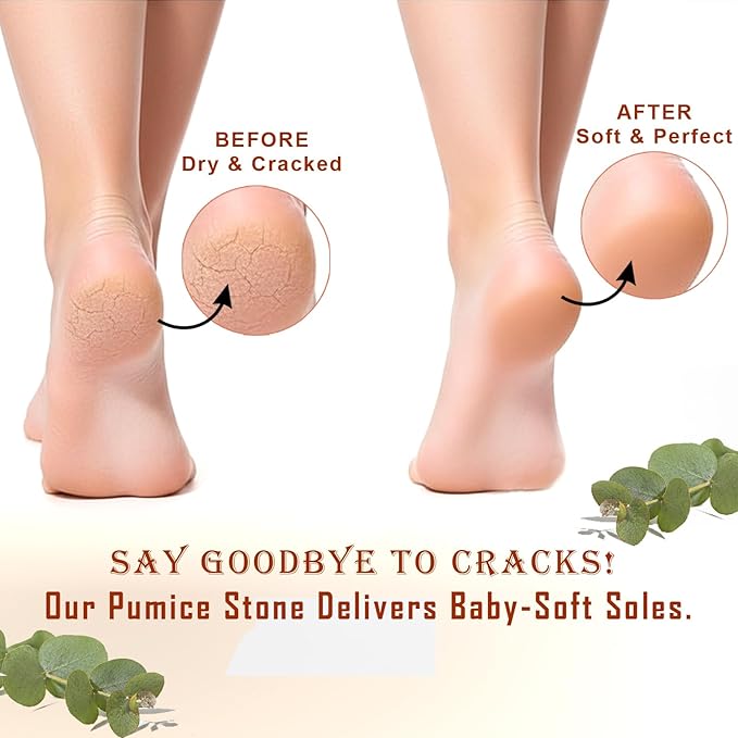 BEAUTICONE 100% Natural Terracotta Pumice Stone for Feet - Durable Callus Remover for Cracked Heels & Dead Skin - Dual Sided Foot Scrubber Pedicure Tool for Foot Care, Foot Exfoliator