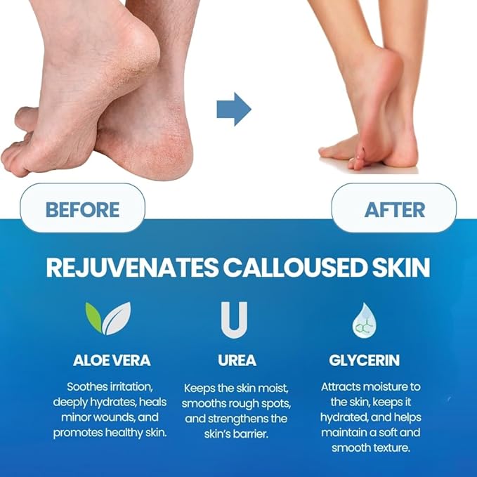 Imperial Feet Callus Softener Spray for Feet Extra Strength – Callus Remover for Feet & Toes, Hard Skin Remover for Dry Cracked Heels, Foot Dead Skin Remover for Pedicure & Foot Care