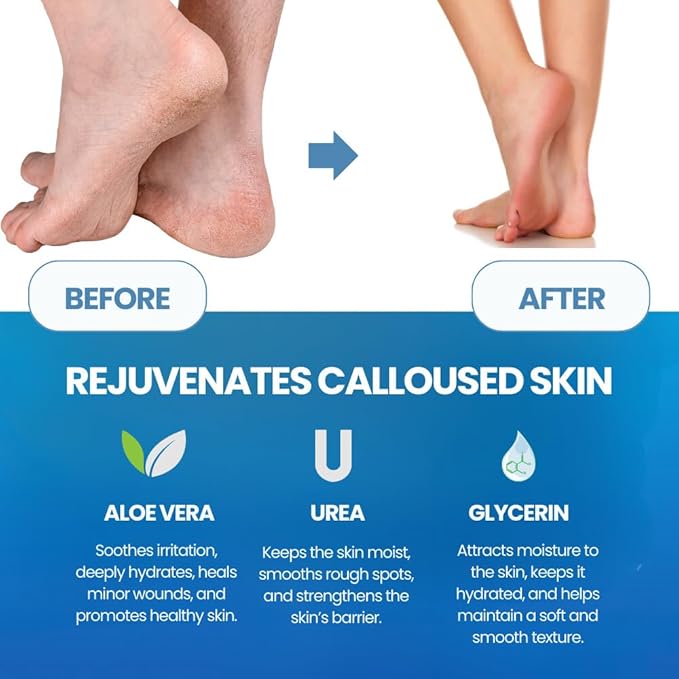 Imperial Feet Callus Remover for Feet Extra Strength Set – Callus Softener Spray + Stainless Steel Foot File, Hard Skin Remover for Dry Cracked Heels, Foot Dead Skin Remover for Pedicure