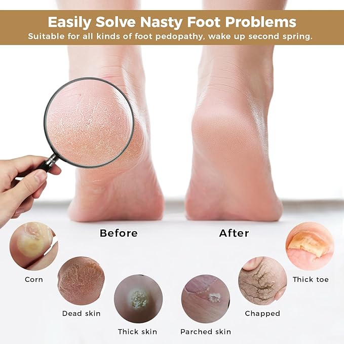 Foot File Scrubber for Dead Skin Remover, Callus Remover for Cracked Heel, Professional Feet Grater Rasp Scraper Corns Callous Removers Tool with Wooden Handle to Hard Skin Corns for Dry & Wet Fee
