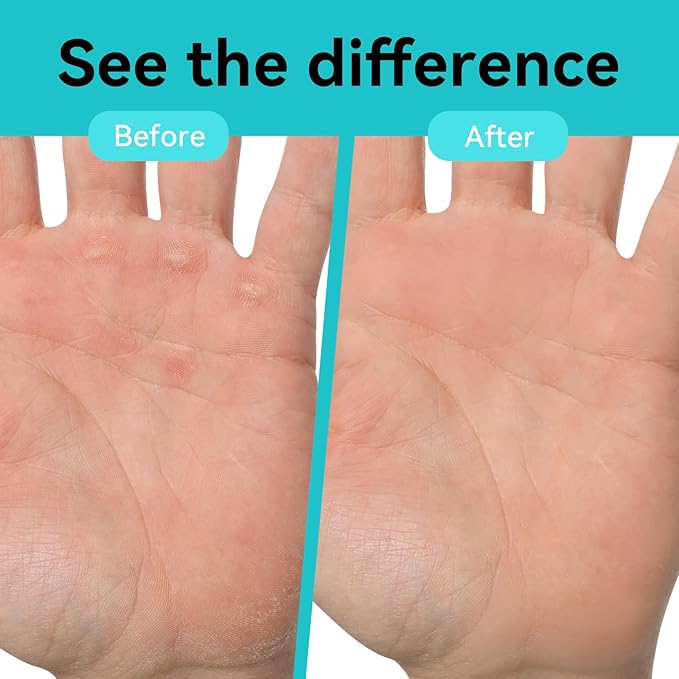 Double Sided Hand&Finger File-Flappers, Rips, Cracks-Strong Smooth Hands - Great for Gym, Rock Climbers
