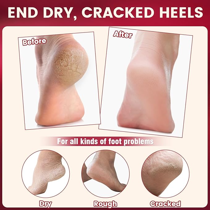 TEAWOO 2 Pcs Cracked Heel Treatment & Repair Stick Set (Foot Balms + Heel Socks) – Rose Oil Infused Cracked Heel Stick Balm for Dry, Cracked Heels – No-Mess Applicator, Travel-Friendly