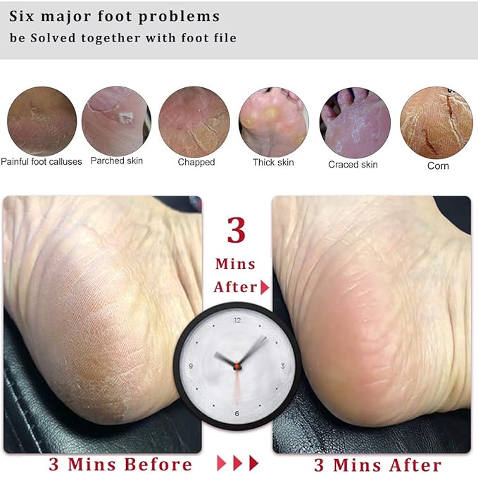 Kinepi Foot File Callus Remover for Feet,Pumice Stone for Feet with Handle,Foot Scrubber and Pedicure Foot Rasp for Cracked Heels, Dead Skin and Hard Skin,Wet and Dry Feet