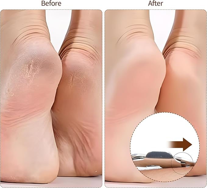 Callus Shaver，Pedicure Foot File Kit，Foot File Callus Remover，Stainless Steel Foot Care Tool for Removing Hard Skin, Cracked Heels, and Dead Skin