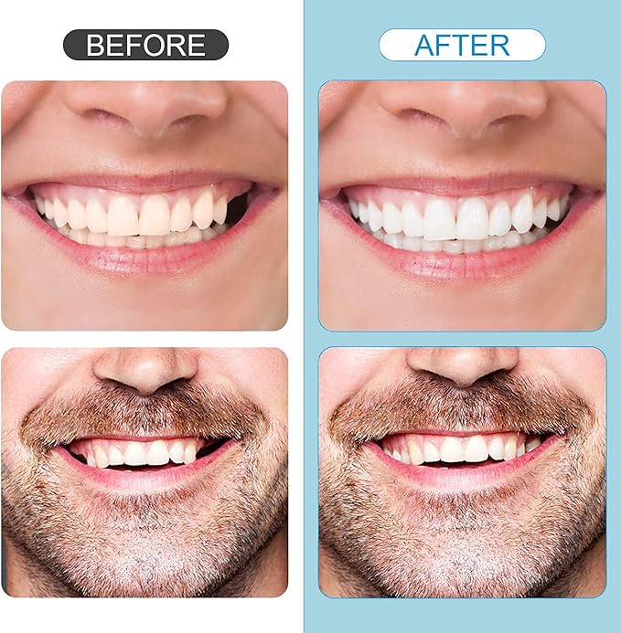 Tooth Repair Kit，Temporary Natural Shade for Filling The Gap, Moldable Thermal Beads Replacement Kit Replace The Missing or Broken Tooth-6PCS-D67